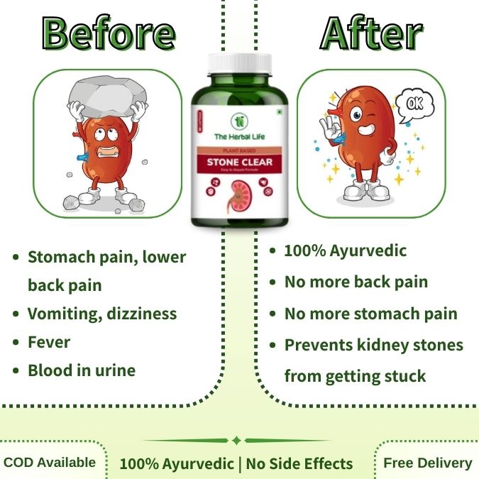 Stone Clear | Natural Kidney Stone Support (Pack of 2)